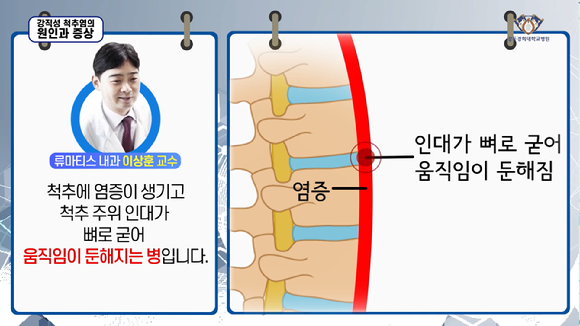 최근 젊은 남성에게서 강직성 척추염이 증가하고 있는 것으로 나타났다. [사진=강동경희대병원]