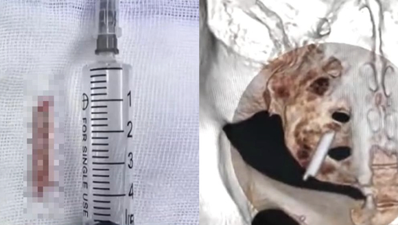 중국 후베이성 우한에 사는 한 여성의 몸속에서 22년 전 박힌 체온계 조각이 뒤늦게 발견돼 이목을 끌고 있다. 사진은 본 기사 내용과 무관. [사진=laketown-naishikyo]