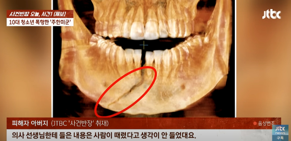 지난 17일 경기 평택시에서 10대 남학생이 30대 주한미군 중사로부터 폭행당해 턱 뼈가 골절되는 일이 발생했다. [사진=사건반장 유튜브 캡처]