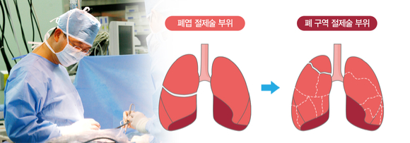 폐암을 조기에 발견하면 폐구역절제술을 통해 폐 가능과 생존율을 높일 수 있다. [사진=강동경희대병원]