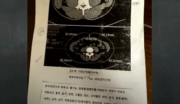 국내 한 병원에서 환자의 지방조직을 '돼지비계'라고 표현한 의사의 언행이 알려졌다. 사진은 여성 A씨가 국내 한 병원에서 촬영한 CT 검사 결과지. [사진=JTBC  사건반장 캡처]