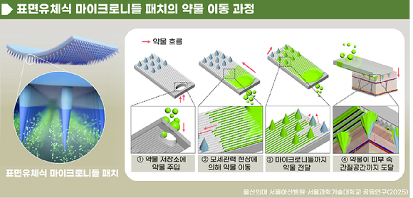 국내 연구팀이 표면유체식 마이크로니들 패치를 개발했다. [사진=서울아산병원]