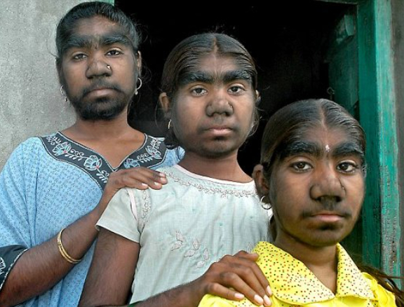 인도의 한 소년이 세계에서 얼굴 털이 가장 많은 사람으로 기네스북에 올랐다. [사진=기네스북]