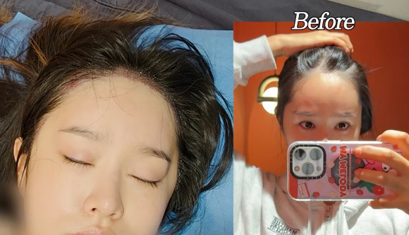 키즈 콘텐츠 유튜버 헤이지니(본명 강혜진)가 최근 모발이식을 받은 근황을 공개했다. [사진=혜진쓰 유튜브 캡쳐]