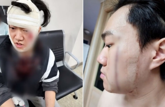 아버지와 아들이 '묻지마 폭행'을 당하는 여성을 구한 사연이 알려졌다. 피해자를 구하는 과정에서 아들 이수연 씨는 얼굴을 크게 다치고도 "피해자가 무사해서 다행"이라고 말했다. [사진=JTBC 보도화면 캡처]