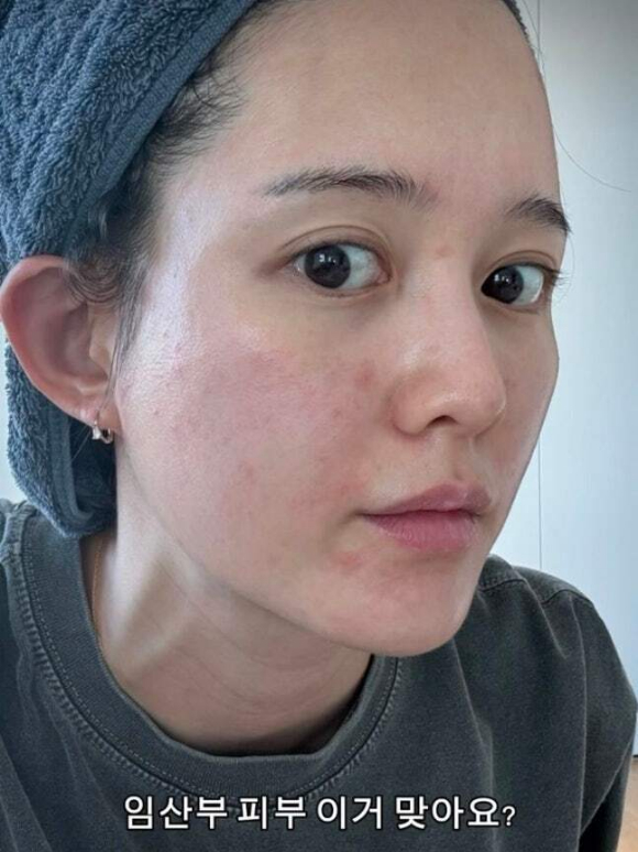 남보라, 임신 후 심각한 피부 상태 "임산부 피부 이거 맞아요?"