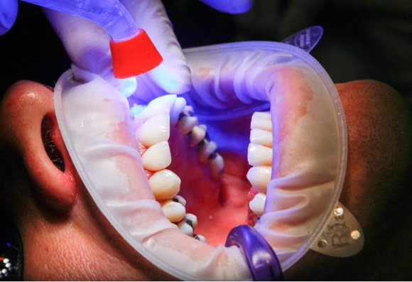 서비스로 제공된 팝콘을 먹고 어금니가 깨졌다며 치료비로 500만원을 요구받은 자영업자의 사연이 전해졌다. 본 기사와 무관한 이미지. [사진=픽사베이]