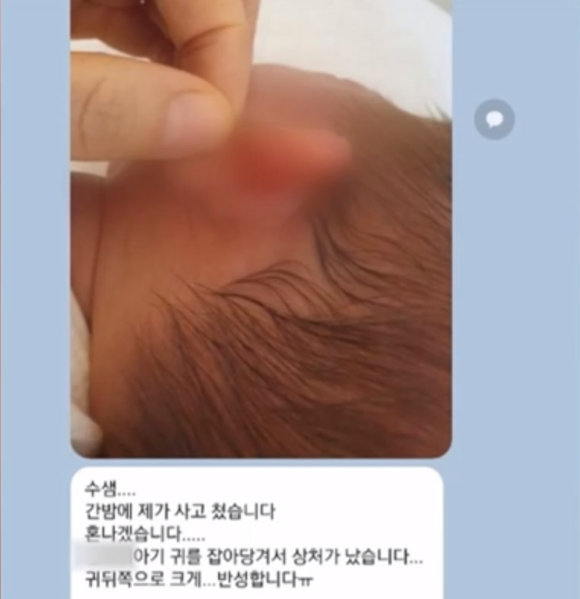 부산의 한 산부인과에서 생후 19일 된 신생아를 학대하고, 간호기록부를 위조하는 등 학대 증거를 은폐한 정황이 확인돼 병원 관계자들이 재판에 넘겨졌다. 사진은 생후 19일 된 신생아의 귓볼이 찢어져 있는 모습. [사진=MBC 방송화면 캡처]