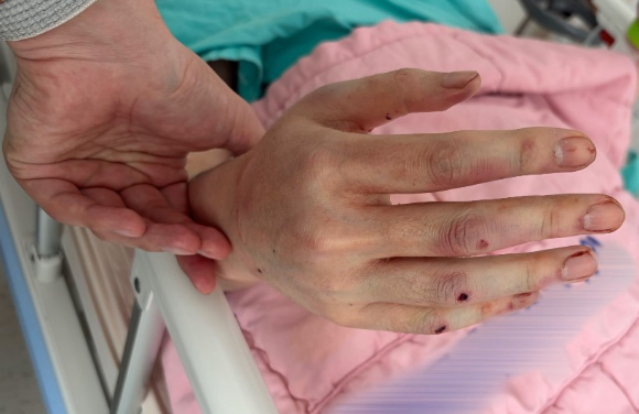 유튜버 수탉이 당시 사건으로 입은 부상 사진 등을 공개했다. [사진=수탉 숲 채널 캡처]