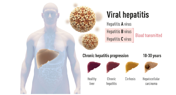 간염은 종류에 따라 서로 다른 증상을 보인다. B형간염 바이러스는 백신이 있다. [사진=NPO]