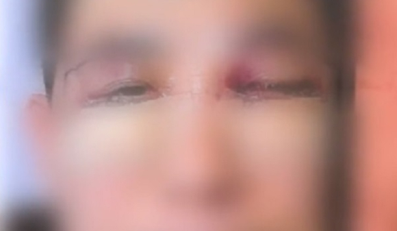 서울 강남의 한 성형외과에서 눈 밑 지방 재배치 수술 등을 받은 환자가 실명하는 사고가 발생했다. [사진=JTBC 보도화면 캡처]