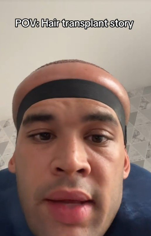 탈모로 인해 모발 이식을 결심한 한 남성이 부작용으로 두피가 부풀어오르는 피해를 입었다. [사진=카나 플렉스 SNS]