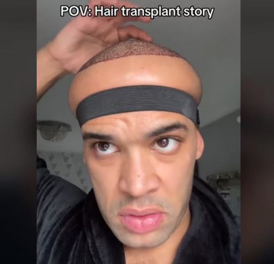 탈모로 인해 모발 이식을 결심한 한 남성이 부작용으로 두피가 부풀어오르는 피해를 입었다. [사진=카나 플렉스 SNS]