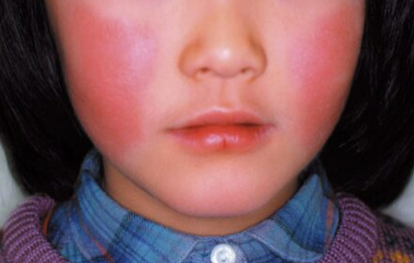 국내 여행객이 많이 찾는 일본 오키나와의 중심 도시 나하시에서 일명 '사과병'으로 불리는 전염성 홍반이 확산하자 현지 보건 당국이 주의를 요했다. 사진은 오키나와 국제거리. [사진=jinw ]