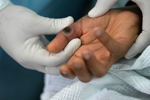 기사와 무관한 이미지. 페루 리마의 한 병원에서 의사가 원숭이 두창에 걸린 한 환자의 손가락을 보여주고 있다.  [사진=뉴시스]