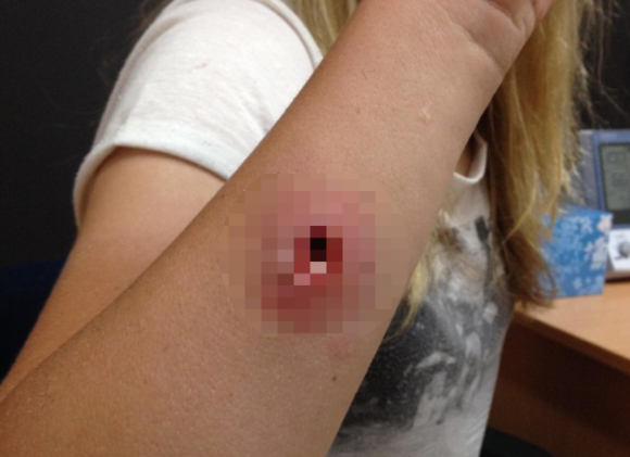 일본 오사카에서 열리고 있는 '2025 오사카&middot;간사이 엑스포'가 맹독성 외래종 거미 출현으로 비상이다. 사진은 붉은등과부거미에 물린 상처 부위로, 오사카 엑스포와는 무관. [사진=yanchepnews]