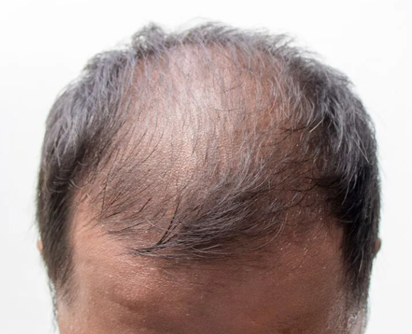 땅콩 추출물이 모발 성장을 촉진하고 탈모을 유발하는 호르몬 생성을 억제한다는 연구 결과가 발표됐다. 사진은 본 기사 내용과 무관함. [사진=The Toronto Hair Transplant Clinic]