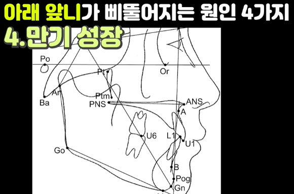 나이가 들면서 아래 앞니가 삐뚤어지는 이유에 대한 전문의의 설명이 나왔다. 사진은 본 기사 내용과 무관함. [사진=Smile Works Dental]