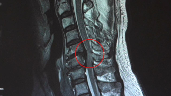 오는 29일 밤 9시 55분에 방송되는 EBS '명의' '목 통증, 원인부터 찾아라 &ndash; 경추 질환' 편에서는 한 번 손상되는 순간 영구적인 후유증이 생길 수 있는 경추 질환과 치료 방법에 대해 알아본다. [사진=EBS]