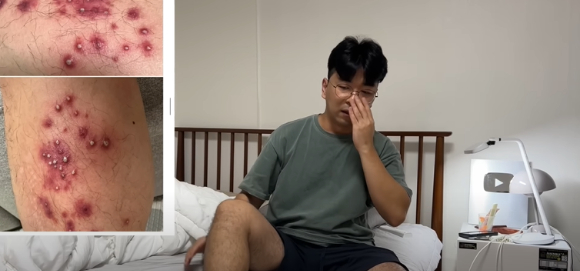지난 14일 유튜브 채널 'Joe튜브'에는 동남아에서 발 마사지를 받고 피부 염증이 생겨 수술까지 받은 남성의 사연이 담긴 영상이 올라왔다. 사진은 유튜브 영상 캡처. [사진=유튜브 채널 'Joe튜브']