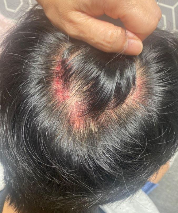 한 10대 중학생이 흉기 난동범으로 오해를 받아 경찰에게 과잉 진압당했다는 주장이 제기됐다. 사진은 해당 학생 아버지가 자신의 아들이 경찰에게 진압당한 뒤 생겼다는 상처. [사진=온라인 커뮤니티 캡처]