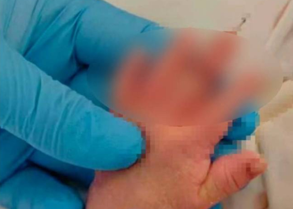 중국에서 제왕절개 수술 도중 간호사의 실수로 신생아의 손가락이 절단되는 사고가 발생해 충격을 주고 있다. 사진은 본 기사 내용과 무관. [사진=EPA/연합뉴스]