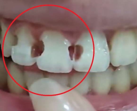 중국에서 5년간 교정 치료를 받아온 20세 여성이 구강 관리 부실로 치아 8개가 심각하게 손상되는 일이 발생했다. 사진은 본 기사 내용과 무관. [사진=픽사베이 @ Vilkasss]