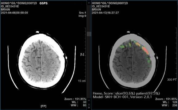 SK C&C의 AI 뇌출혈 영상 의료 솔루션 ‘메디컬 인사이트 플러스 뇌출혈’ 데모(Demo) 화면 [사진=SK C&C]
