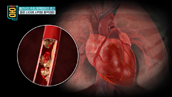 방심하면 돌연사까지, 가볍게 넘겼던 증상들이 심혈관질환의 원인일 수 있다. [사진=EBS]