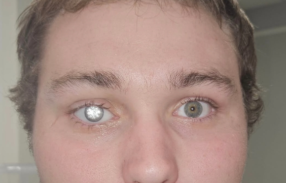 미국에서 2캐럿짜리 다이아몬드가 박힌 의안을 착용한 남성의 사연이 공개됐다. 사진은 다이아몬드 의안을 착용한 존스. [사진=인스타그램 @artificialeyesbyjohnimm]