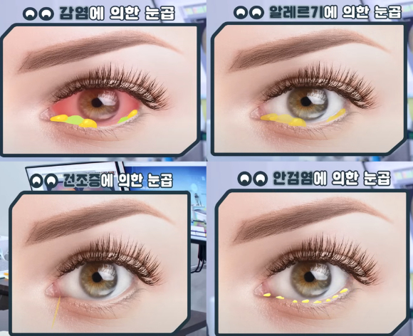 눈곱의 색과 형태만으로도 눈 건강 상태를 가늠할 수 있다는 안과 전문의의 설명이 공개됐다. 사진은 본 기사 내용과 무관. [사진=MyVision.org]