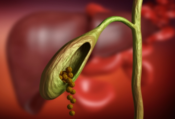 치즈를 규칙적으로 섭취하면 담석증 발병 위험을 낮출 수 있다는 대규모 연구 결과가 공개됐다. 사진은 본 기사 내용과 무관. [사진=픽사베이 ]