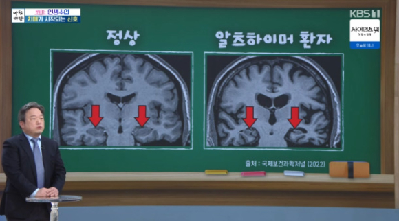 '아침마당' 최호진 "치매 신호, 성격 변화·익숙했던 일의 어려움·맛 변화"