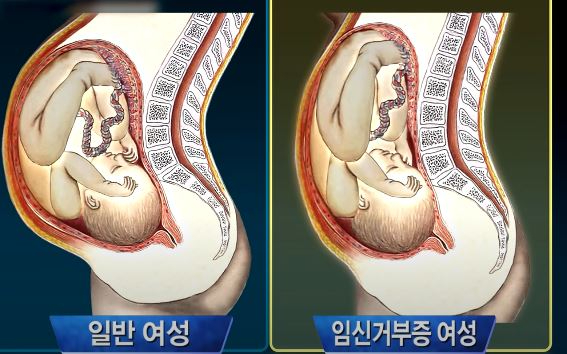 베로니크는 자궁이 길어져 일반 임신부에 비해 배가 나오지 않고, 생리로 착각할 수 있는 출혈이 동반되는 '임신거부증'을 앓고 있었고 이 때문에 남편인 쿠르죠는 아내의 임신 사실조차 알지 못했던 것이다. 사진은 임신한 일반 여성과 임신거부증을 앓고 있는 여성들의 임신 당시 차이. [사진=SBS '그것이 알고싶다' 화면 캡처]