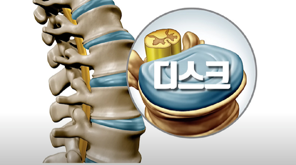 아침에 하는 허리 스트레칭의 경우에는 디스크가 터질 수도 있는 위험한 행동이다. [사진=픽사베이]