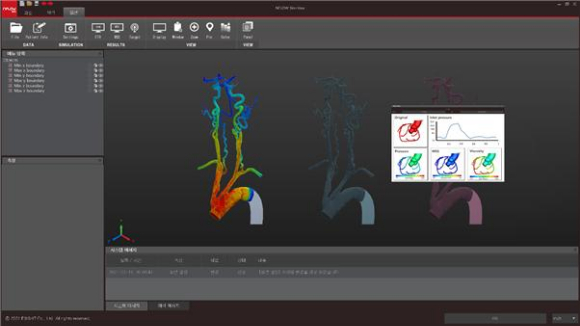 이에이트의 NFLOW 기술을 이용한 경동맥 혈류 역학 시뮬레이션 [사진=이에이트]