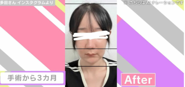 최근 한국에서 양악수술, 안면윤곽수술 등을 받았다고 고백한 일본 인플루언서 타다(33)씨(왼쪽). [사진=아베마 타임스]
