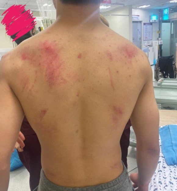 한 10대 중학생이 흉기 난동범으로 오해를 받아 경찰에게 과잉 진압당했다는 주장이 제기됐다. 사진은 해당 학생 아버지가 자신의 아들이 경찰에게 진압당한 뒤 생겼다는 상처. [사진=온라인 커뮤니티 캡처]