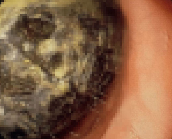 수개월 동안 복통과 구토를 겪어온 20대 여성의 복부에서 머리카락 덩어리가 발견됐다는 의료 사례가 공개됐다. 사진은 본 기사 내용과 무관. [사진=픽사베이 @Saranya7]