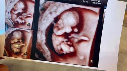 홍현희-제이쓴 부부가 임신 소식을 알렸다. 사진은 초음파 사진. [사진=제이쓴 인스타그램 ]