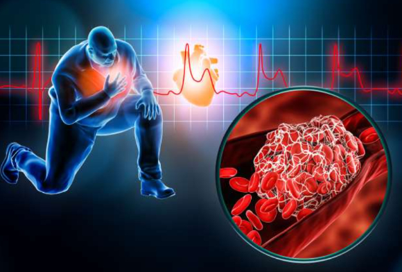  심장마비가 의심되는 상황에서는 '아스피린'을 씹어 복용하는 것이 효과적이라는 전문의 설명이 제시됐다. 사진은 본 기사 내용과 무관. [사진=UCLA Health]