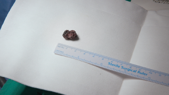 매년 30만 명이 넘는 환자들이 요로결석으로 고통받고 있다. 사진은 요로결석. [사진=EBS]