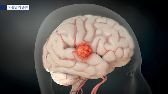 뇌를 포함해 두개골 어디든 생기는 뇌종양은 복잡하고 다양한 기능이 있는 뇌는 손상되면 생명은 물론 치명적인 후유증을 남긴다. [사진=EBS]