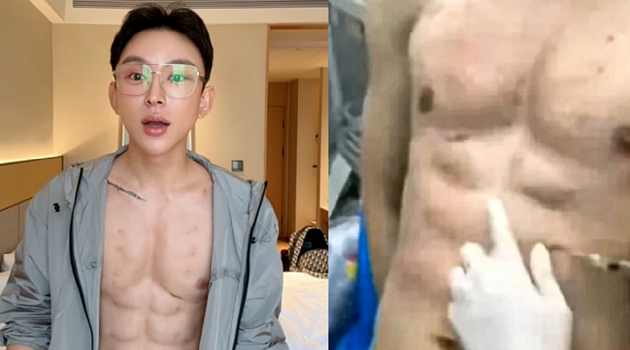중국의 한 남성이 8억원이 넘는 돈을 들여 인공적으로 '8팩 복근'을 만들었다고 주장해 화제다. 사진은 해당 남성과 시술 과정. [사진=더우인]