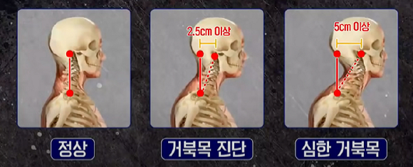 현대인의 고질병 거북목 [사진=pixabay]