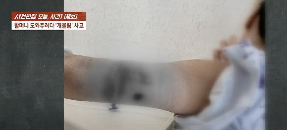 진돗개에게 물려 전치 3주의 부상을 당했지만, 견주에게 치료비도 받지 못하고 있다는 예비 신부의 사연이 전해졌다. 사진은 사고 당시 상황. [사진=JTBC]