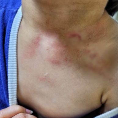 지난 6월부터 어린이집 보육교사에게 폭행을 당한 피해 아동의 목 부위 상처 [사진=YTN 보도 영상 캡처]