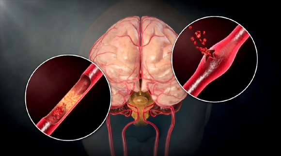 뇌졸중은 한순간에 삶 전체를 뒤흔드는 무서운 질환이다. 하지만 고장 난 뇌도 다시 되살릴 수 있는 기회가 있다. [사진=EBS]