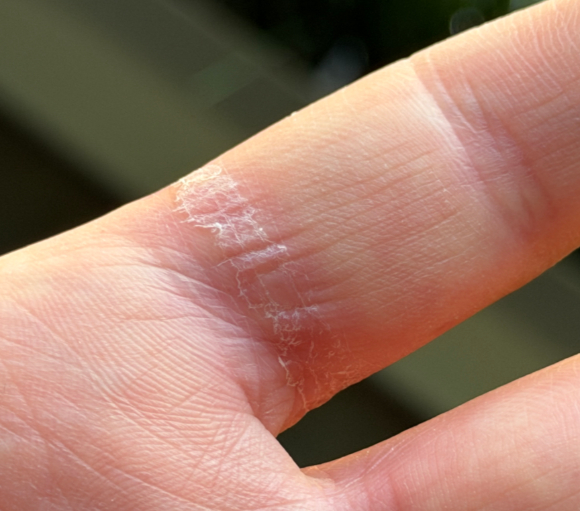 삼성전자의 스마트 반지형 웨어러블 '갤럭시 링'에서 배터리가 팽창했다는 주장이 해외 유튜버를 통해 제기돼 논란이 일고 있다. 사진은 해당 제품 배터리가 팽창한 모습. [사진= X @Daniel]