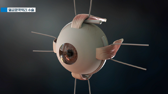 오는 23일 오후 9시 55분에 방송되는 EBS '명의' '실명할 수 있습니다 - 망막박리' 편에서는 실명의 위험에 처한 환자들의 치료에 매진하는 안과 이성진 교수와 망막박리의 원인과 치료법, 그리고 예방법을 알아보는 시간을 가진다. [사진=EBS]